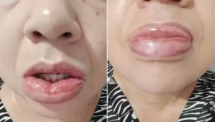 Mais de 1,2 mil pessoas relataram reações adversas após uso de creme dental da Colgate